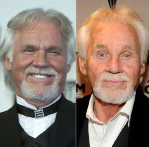 Kenny Rogers plastic surgery